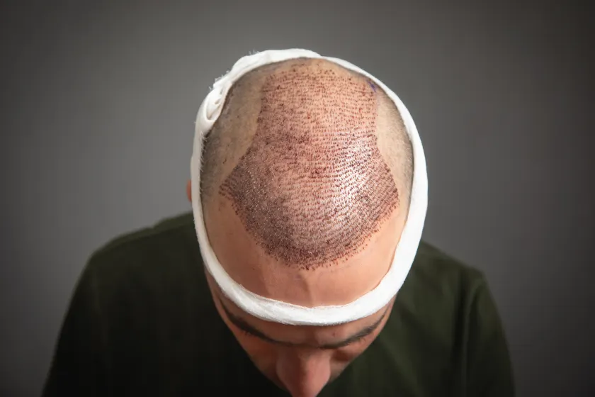 Illustrative image representing Hair Restoration treatments at Novelle Aesthetics