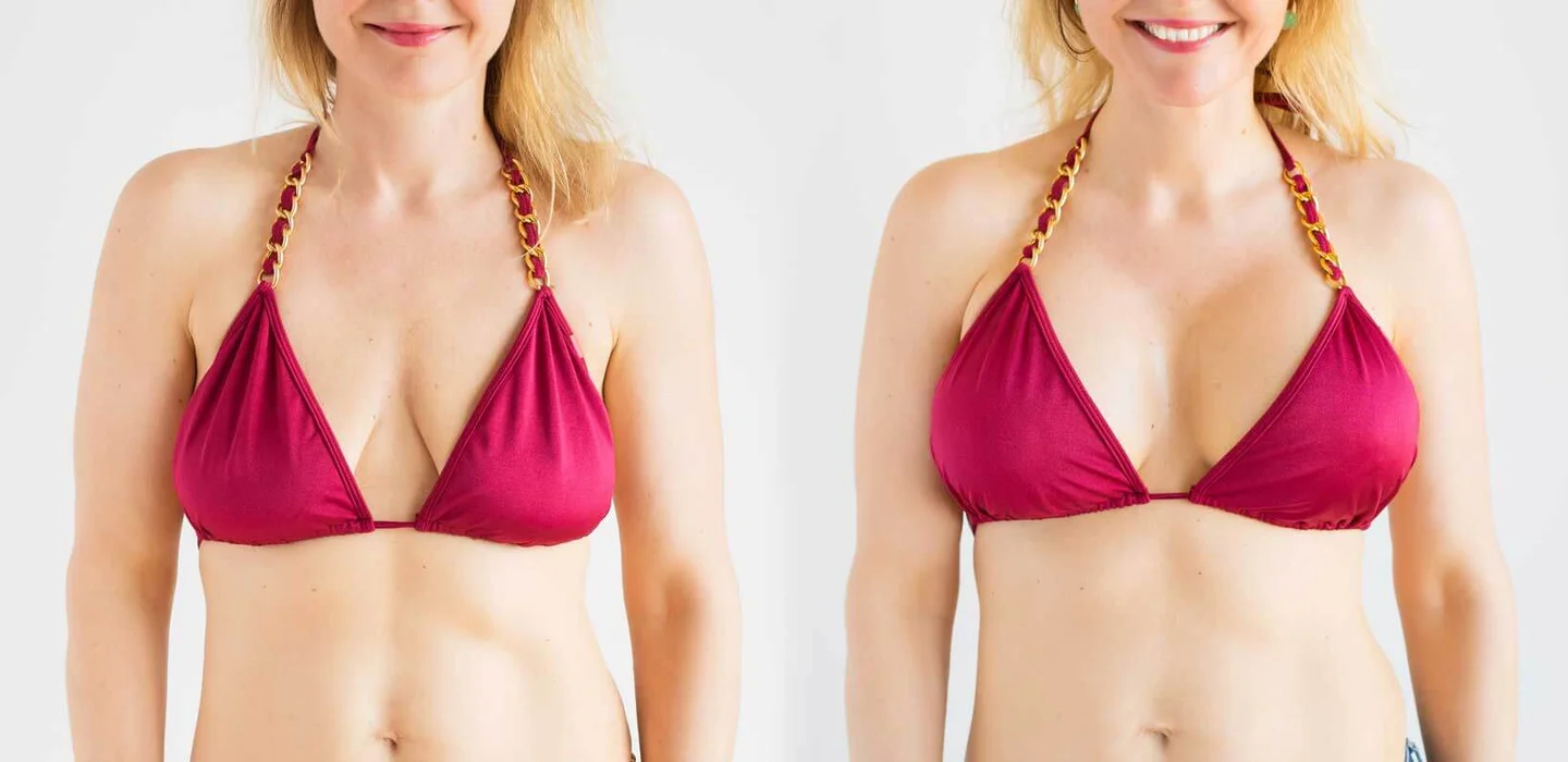 Illustrative image representing Breast Lift (Mastopexy) at Novelle Aesthetics