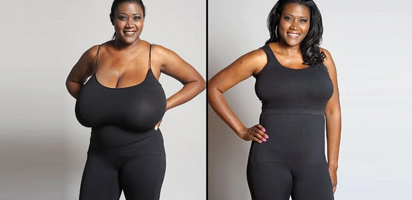 Illustrative image representing Breast Reduction at Novelle Aesthetics
