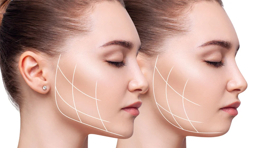 Illustrative image representing Buccal Fat Removal at Novelle Aesthetics