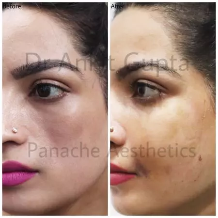 Illustrative image representing Facial Fat Transfer at Novelle Aesthetics