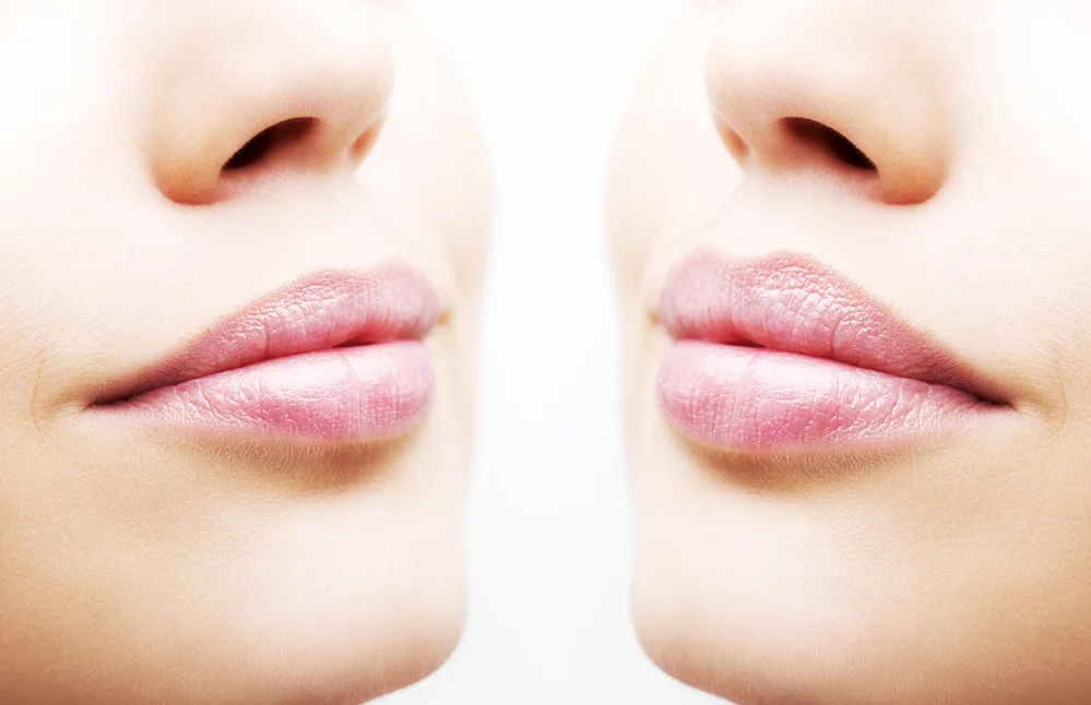 Illustrative image representing Lip Lift at Novelle Aesthetics
