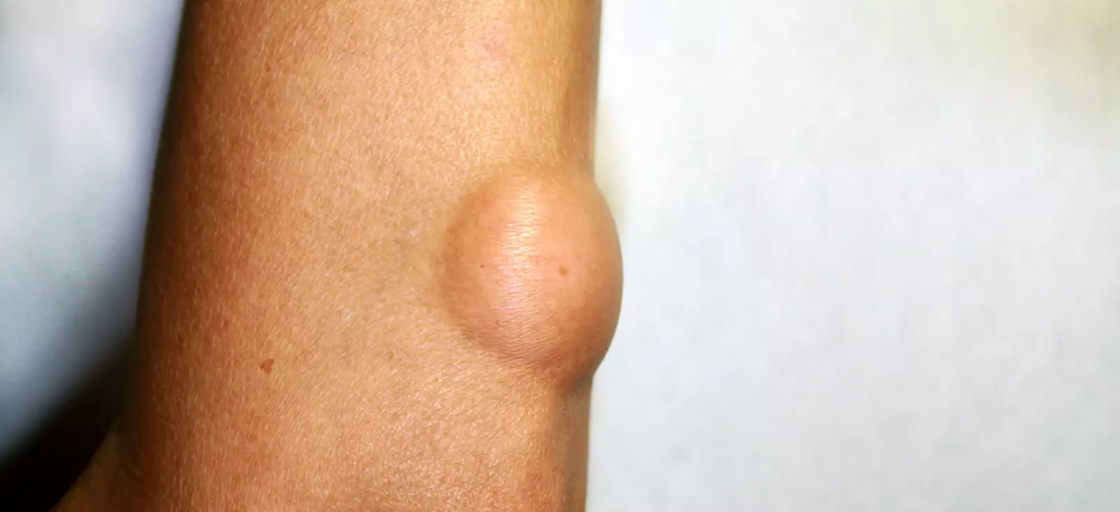 Illustrative image representing Lipoma & Cyst Removal at Novelle Aesthetics