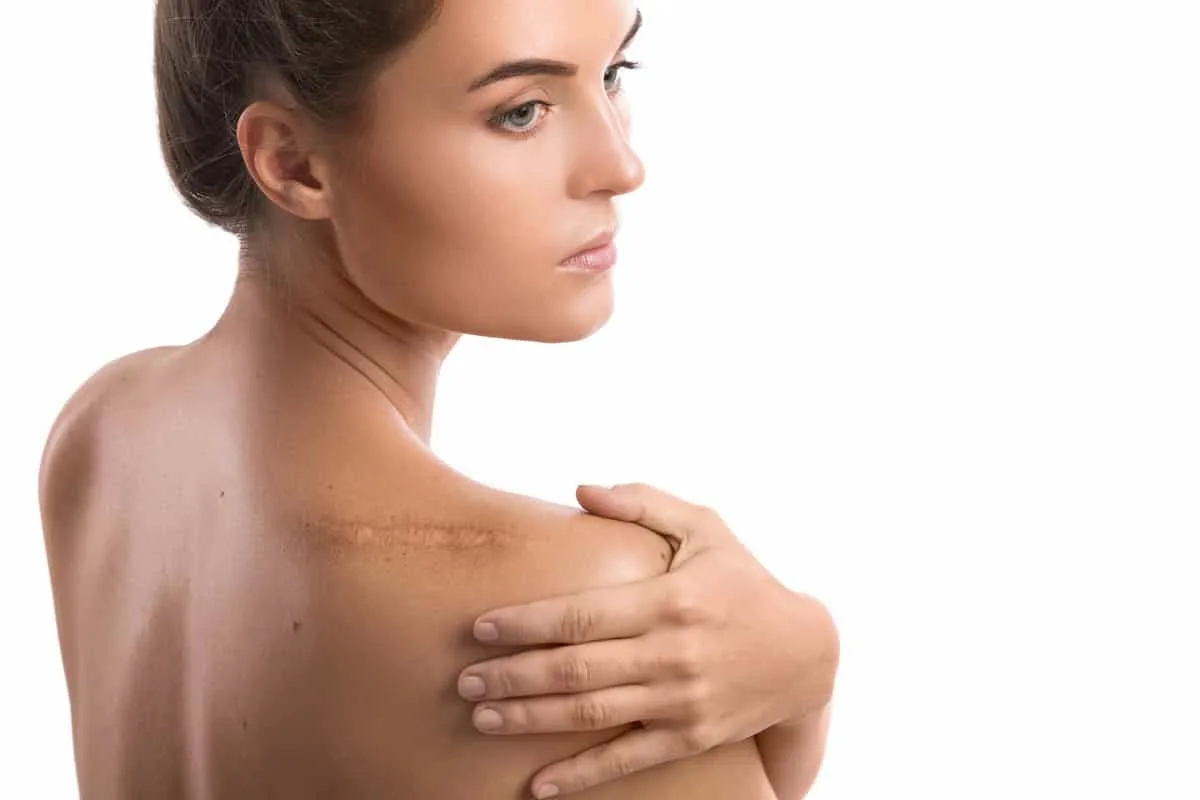 Illustrative image representing Scar Revision at Novelle Aesthetics